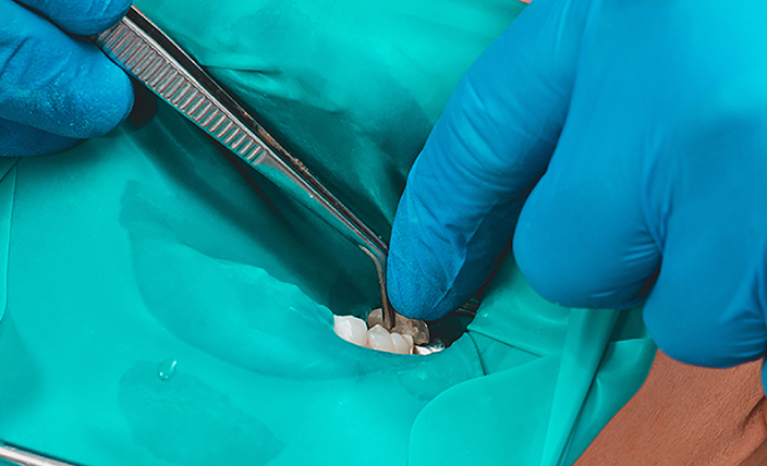 ラバーダム防湿による感染対策の様子