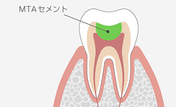 保険診療で使用されるガッタパーチャ材