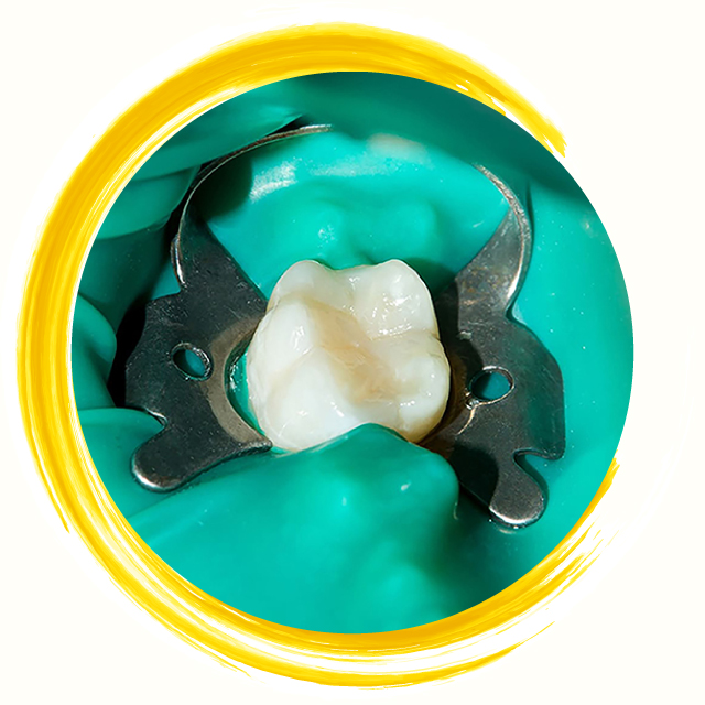 ラバーダム防湿による無菌的環境の維持